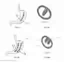 Fig. 04 - Methods and devices for reducing gastric volume