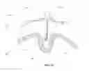 Fig. 09 - Methods and devices for reducing gastric volume
