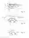 Fig. 13 - Devices and methods for altering eating behavior