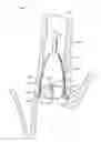Fig. 01 - Removable anchored lung volume reduction devices and methods
