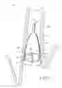 Fig. 05 - Removable anchored lung volume reduction devices and methods
