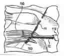 Fig. 01 - Method for knotless fixation of tissue with swivel anchor