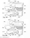 Fig. 14 - Devices and methods for facilitating controlled bone growth or repair
