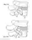 Fig. 18 - Devices and methods for facilitating controlled bone growth or repair
