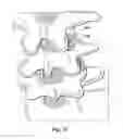 Fig. 19 - Devices and methods for facilitating controlled bone growth or repair