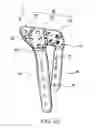 Fig. 03 - Bone plate structure