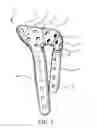 Fig. 07 - Bone plate structure
