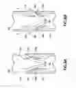 Fig. 06 - BONE FRACTURE TREATMENT DEVICES AND METHODS OF THEIR USE