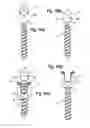 Fig. 06 - Polyaxial bone anchoring device