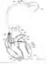 Fig. 12 - Systems and methods for determining optimal interventricular pacing delays based on electromechanical delays