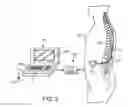 Fig. 03 - Neurostimulation system for estimating desired stimulation amplitude for electrode configuration