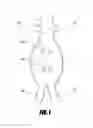 Fig. 02 - Stent graft