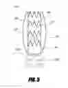 Fig. 07 - Stent graft