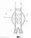 Fig. 09 - Stent graft