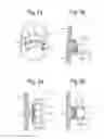 Fig. 02 - FIXING DEVICE, IN PARTICULAR FOR FIXING TO VASCULAR WALL TISSUE