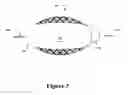 Fig. 04 - Cement-directing orthopedic implants