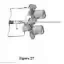 Fig. 28 - Cement-directing orthopedic implants