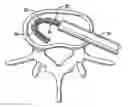 Fig. 01 - Spinal implant and method of use