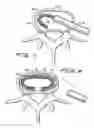 Fig. 05 - Spinal implant and method of use
