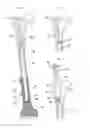 Fig. 02 - Implantable prosthesis for replacing a human hip or knee joint and the adjoining bone sections