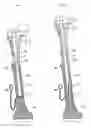 Fig. 03 - Implantable prosthesis for replacing a human hip or knee joint and the adjoining bone sections