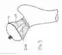 Fig. 05 - SOCKET AND PROSTHESIS FOR JOINT REPLACEMENT