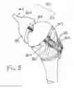 Fig. 10 - SOCKET AND PROSTHESIS FOR JOINT REPLACEMENT