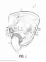Fig. 02 - PATIENT INTERFACE DEVICE INCLUDING A MECHANISM FOR MANIPULATING THE POSITION OF AN INTERNAL COMPONENT THEREOF