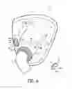 Fig. 06 - PATIENT INTERFACE DEVICE INCLUDING A MECHANISM FOR MANIPULATING THE POSITION OF AN INTERNAL COMPONENT THEREOF