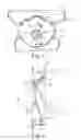 Fig. 02 - VALVE HAVING AN ABLATED FLAP