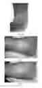 Fig. 04 - USE OF PHARMACEUTICAL COMPOSITIONS IN PREPARING PHARMACEUTICALS FOR TREATING DIABETIC ULCER
