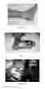 Fig. 05 - USE OF PHARMACEUTICAL COMPOSITIONS IN PREPARING PHARMACEUTICALS FOR TREATING DIABETIC ULCER
