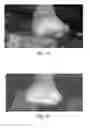 Fig. 09 - USE OF PHARMACEUTICAL COMPOSITIONS IN PREPARING PHARMACEUTICALS FOR TREATING DIABETIC ULCER
