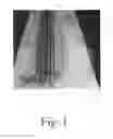 Fig. 02 - Welded, laminated apparatus, methods of making, and methods of using the apparatus