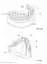 Fig. 02 - Dental bridge attachment system and method