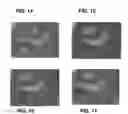 Fig. 12 - Enhanced deposition of chromogens