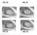 Fig. 16 - Enhanced deposition of chromogens