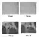 Fig. 20 - Enhanced deposition of chromogens