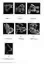 Fig. 03 - Method for Selectively Damaging and Killing Tumor Cells and Apparatus Therefor