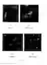Fig. 04 - Method for Selectively Damaging and Killing Tumor Cells and Apparatus Therefor