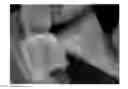 Fig. 01 - Surface-etched etched alumina/SiC mini-whisker composite material and uses thereof