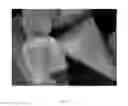 Fig. 02 - Surface-etched etched alumina/SiC mini-whisker composite material and uses thereof