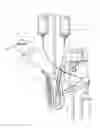 Fig. 01 - Impeller housing for percutaneous heart pump