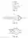 Fig. 29 - Impeller housing for percutaneous heart pump
