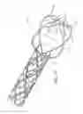 Fig. 33 - Impeller housing for percutaneous heart pump