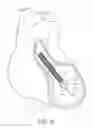 Fig. 34 - Impeller housing for percutaneous heart pump