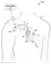 Fig. 01 - Implantable medical device fixation