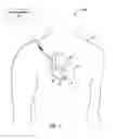 Fig. 02 - Implantable medical device fixation