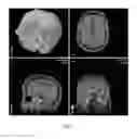 Fig. 02 - Method of rapidly visualizing essential neural pathways