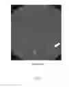 Fig. 03 - METHOD OF CT ANGIOGRAPHY TO VISUALIZE TRANS-OSSEOUS BLOOD VESSELS